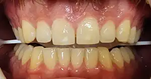 A picture of a smile featuring aesthetically pleasing teeth.