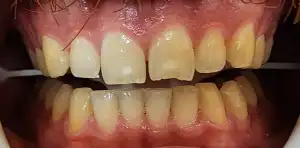 A picture of a smile featuring chipped front teeth.