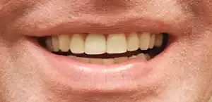 A picture of a smile featuring aesthetically pleasing teeth.