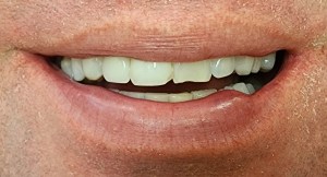A picture of a smile featuring chipped front teeth.