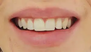 A picture of a smile featuring aesthetically pleasing teeth.