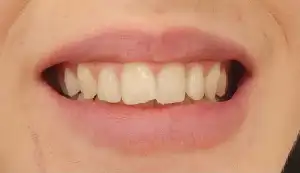 A picture of a smile featuring chipped front teeth.