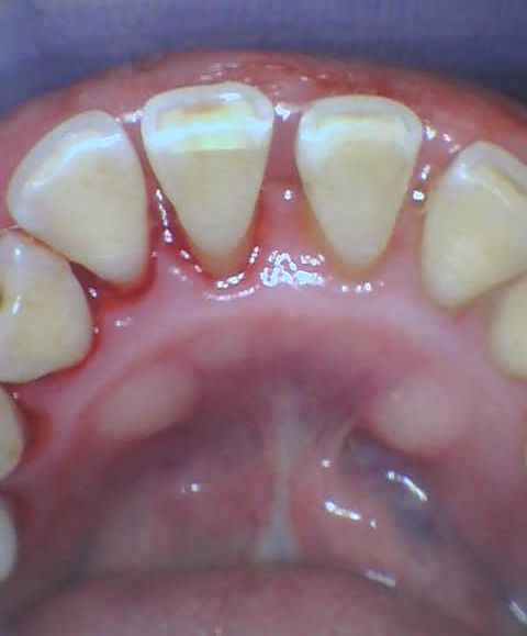 after Cleaning and Polishing