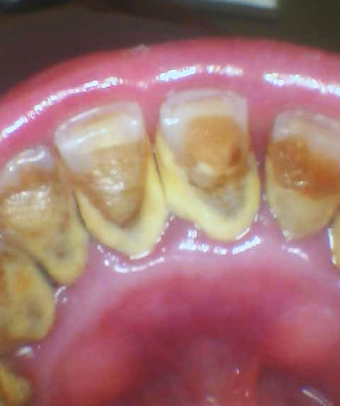 before Cleaning and Polishing