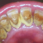 before Cleaning and Polishing