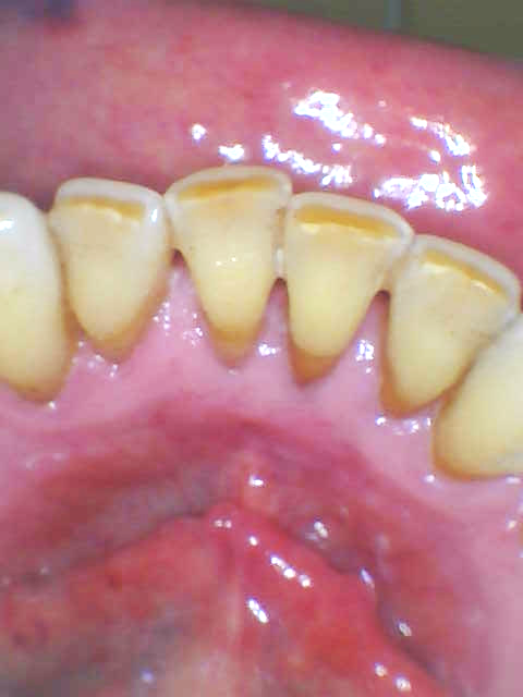 before Cleaning and Polishing