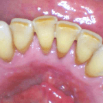 before Cleaning and Polishing