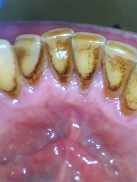 before Cleaning and Polishing