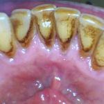before Cleaning and Polishing