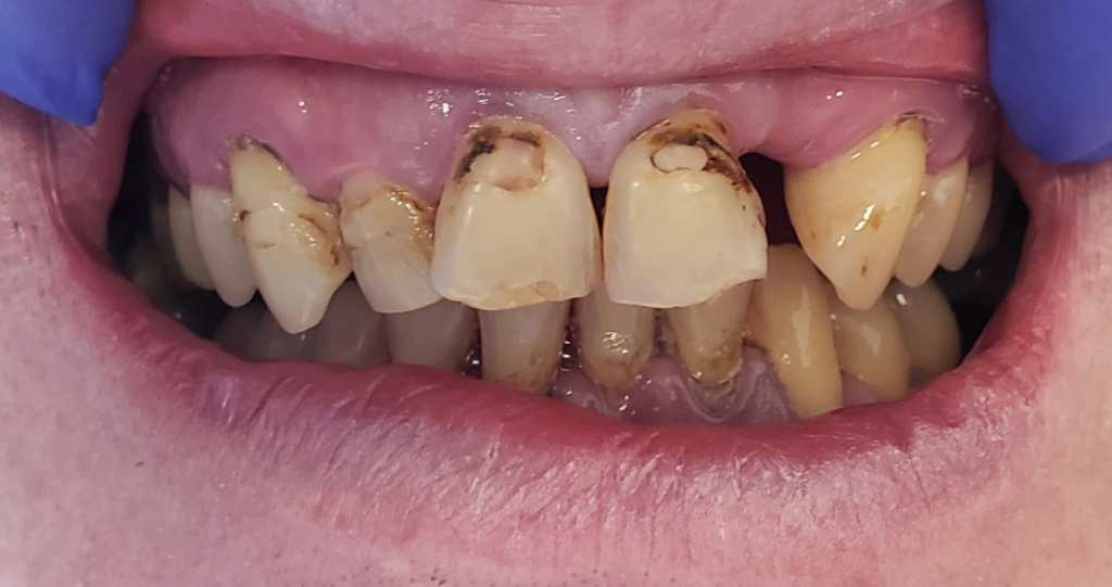 before Cleaning and Polishing