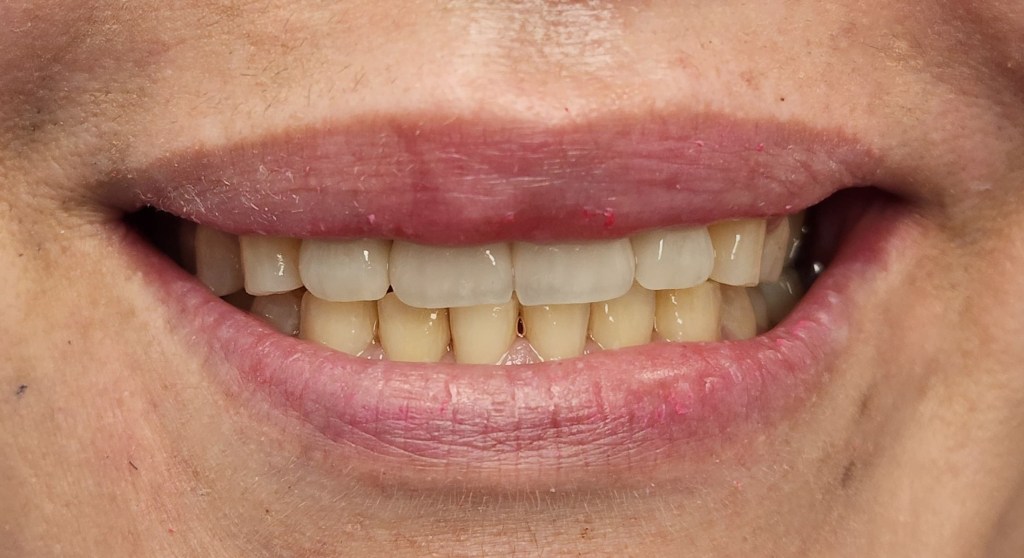 after Anterior Crowns