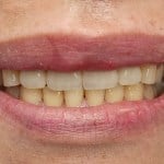 after Anterior Crowns
