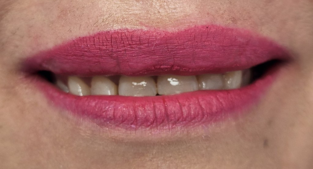 before Anterior Crowns