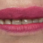 before Anterior Crowns