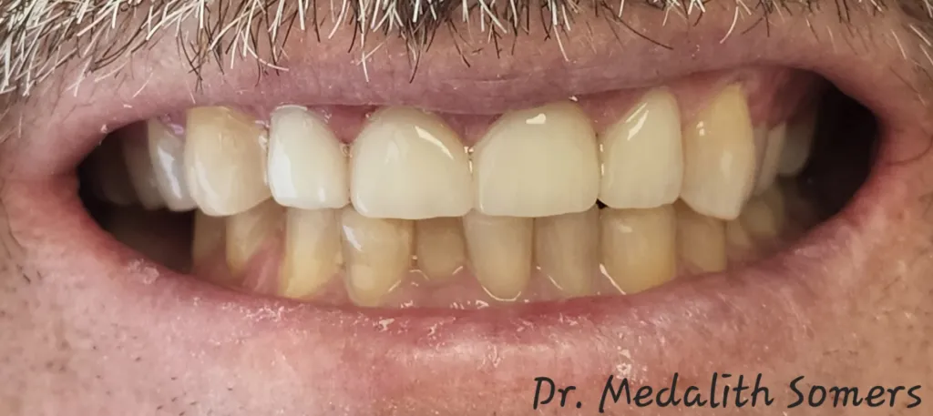 after Restoring Teeth Affected by Severe Grinding with Crowns