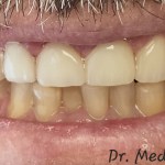 after Restoring Teeth Affected by Severe Grinding with Crowns