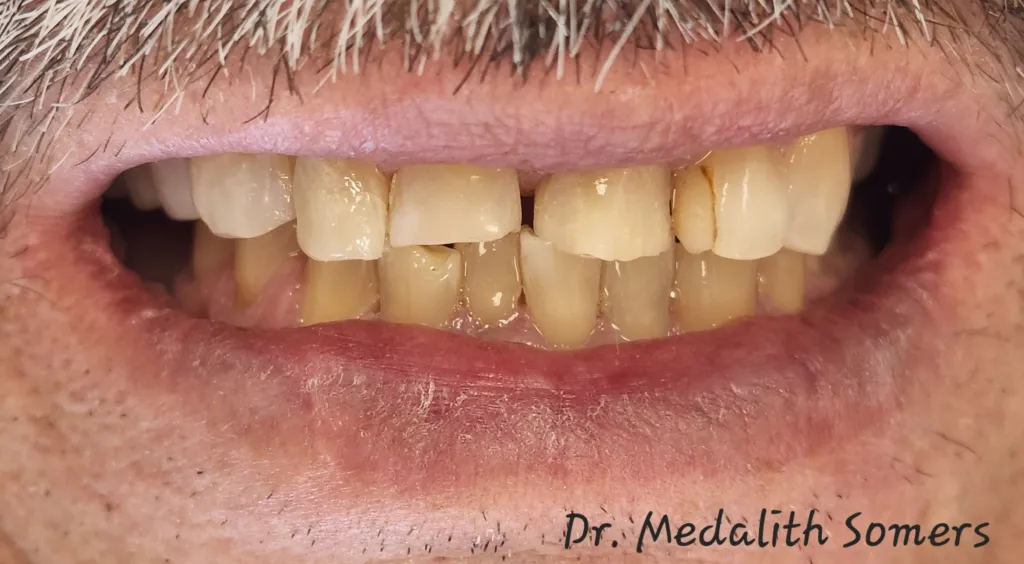 Before Restoring Teeth Affected by Severe Grinding with Crowns