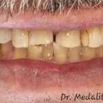 Before Restoring Teeth Affected by Severe Grinding with Crowns
