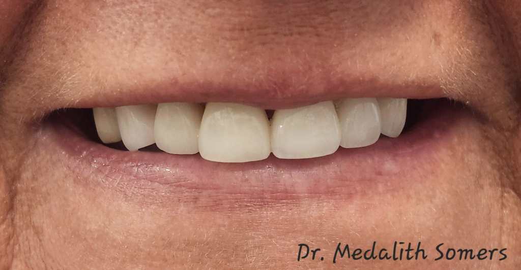 after Straightening Crooked Teeth and Restoring Brightness
