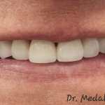 after Straightening Crooked Teeth and Restoring Brightness