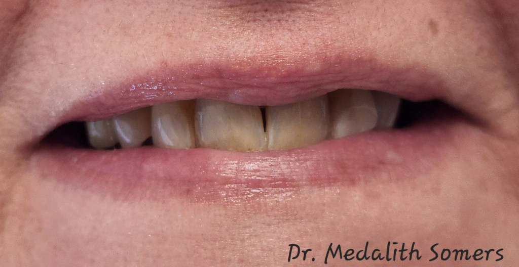 before Straightening Crooked Teeth and Restoring Brightness