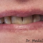before Straightening Crooked Teeth and Restoring Brightness